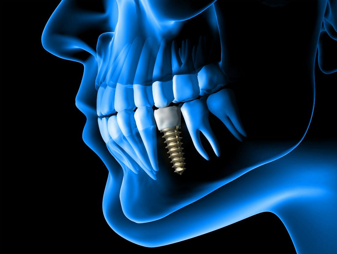 Dental Implants Springfield, NJ