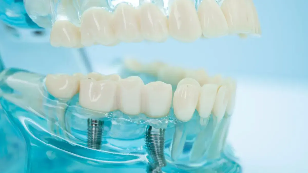 What Types of Dental Implants Are There?