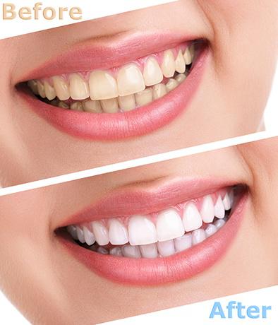 Zoom! teeth whitening special offer Springfield, NJ dentist
